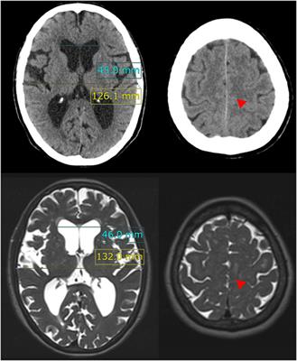 Fluid Distribution Pattern in Adult-Onset Congenital, Idiopathic, and Secondary Normal-Pressure Hydrocephalus: Implications for Clinical Care